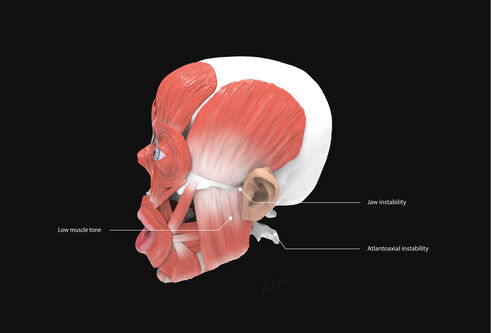 Profile view of labeled muscles on Down syndrome écorché
