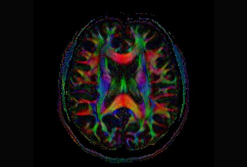 Colourful scan of a human brain with Alzheimer's 