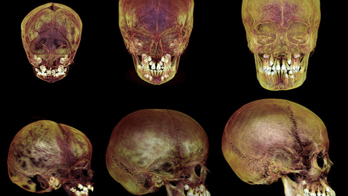 images of children's skulls