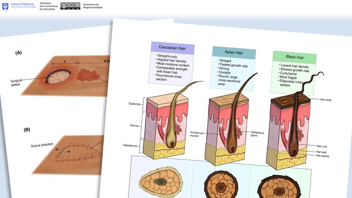 Illustrations of hair follicle structure and a pedicle flap by Meghana Mokhasi.