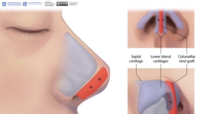 Illustration showing a columellar strut graft.
