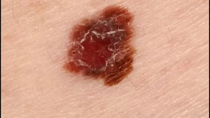 Pic of skin cancer