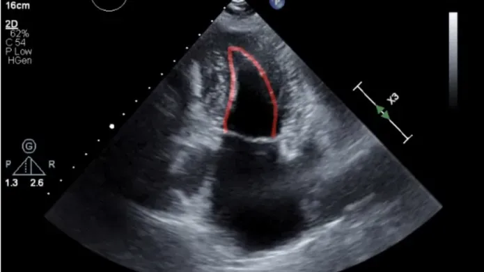 Image shows an area of abnormality detected in a echocardiography heart scan. Credit Us2.ai