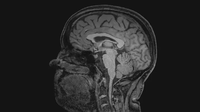 Black and white scan of a patient with Alzheimer's brain 