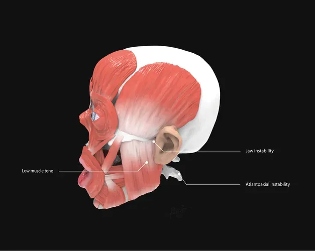 Profile view of labeled muscles on Down syndrome écorché