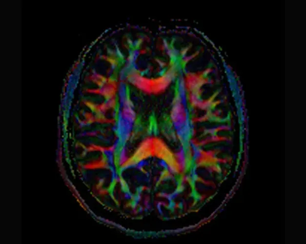 Colourful scan of a human brain with Alzheimer's 