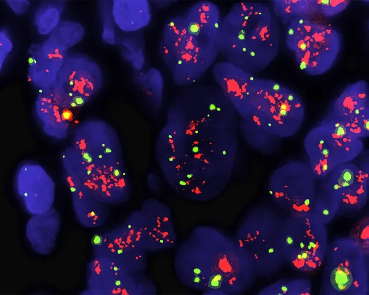 a microscopic image of breast cancer cells