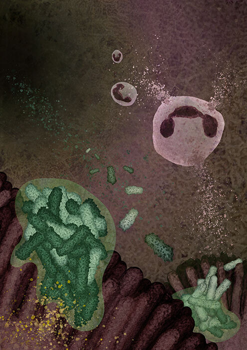 A neutrophil attacking a Pseudomonas aeruginosa biofilm on the airway epithelial surface