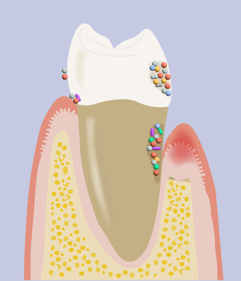 Illustration showing bacteria on a diseased tooth