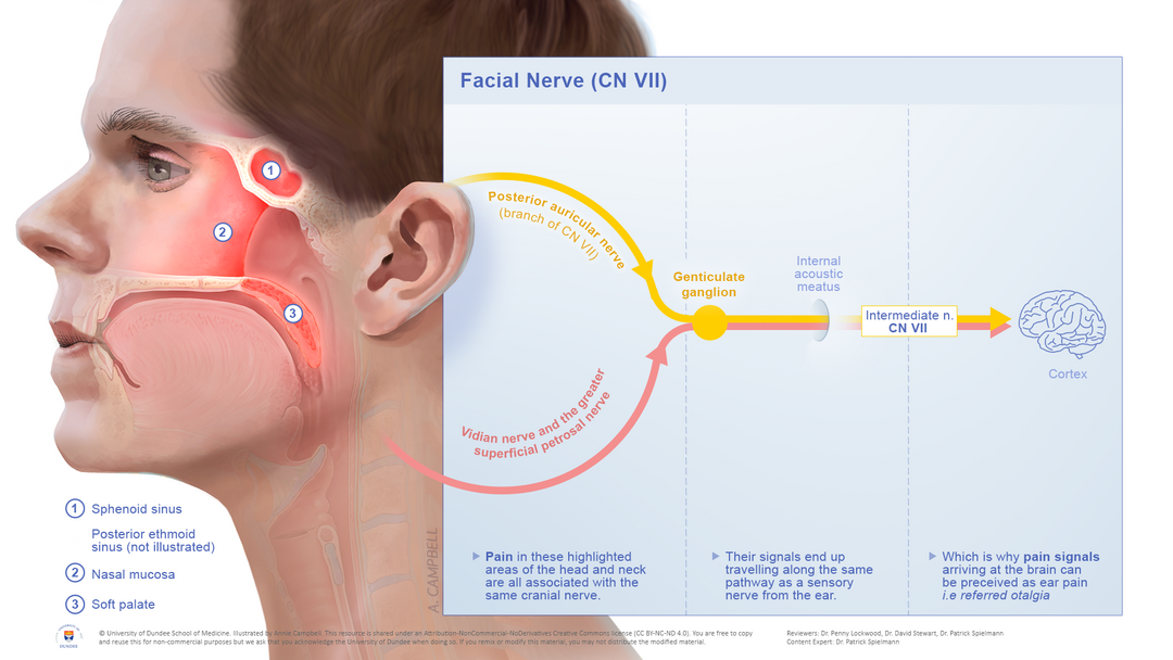 Medical illustration of referred otalgia and cranial nerves III, X, IX, XII