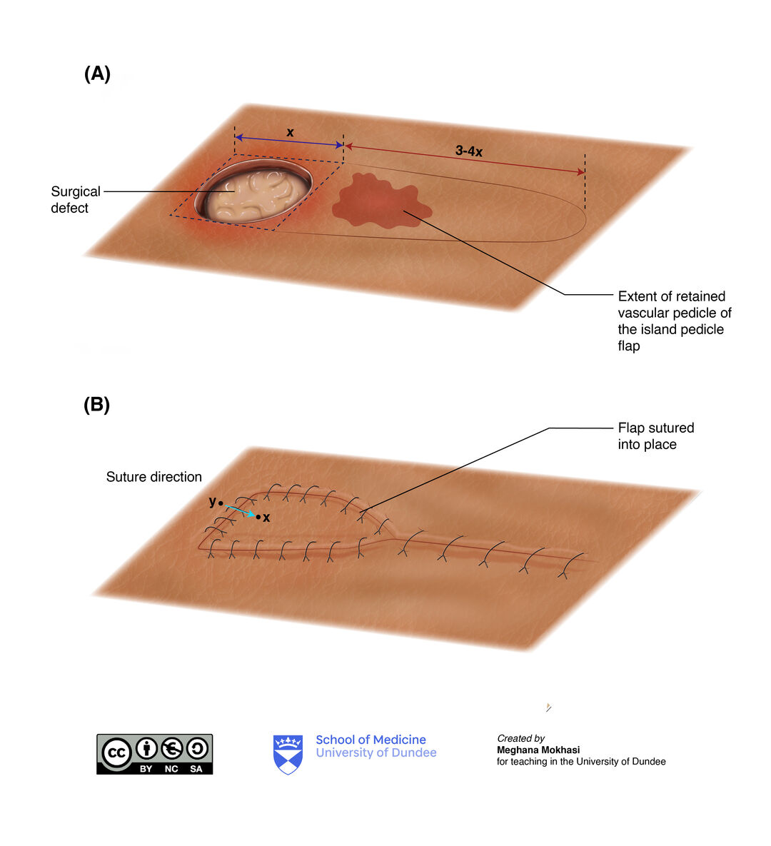 Illustration of the pedicle flap technique
