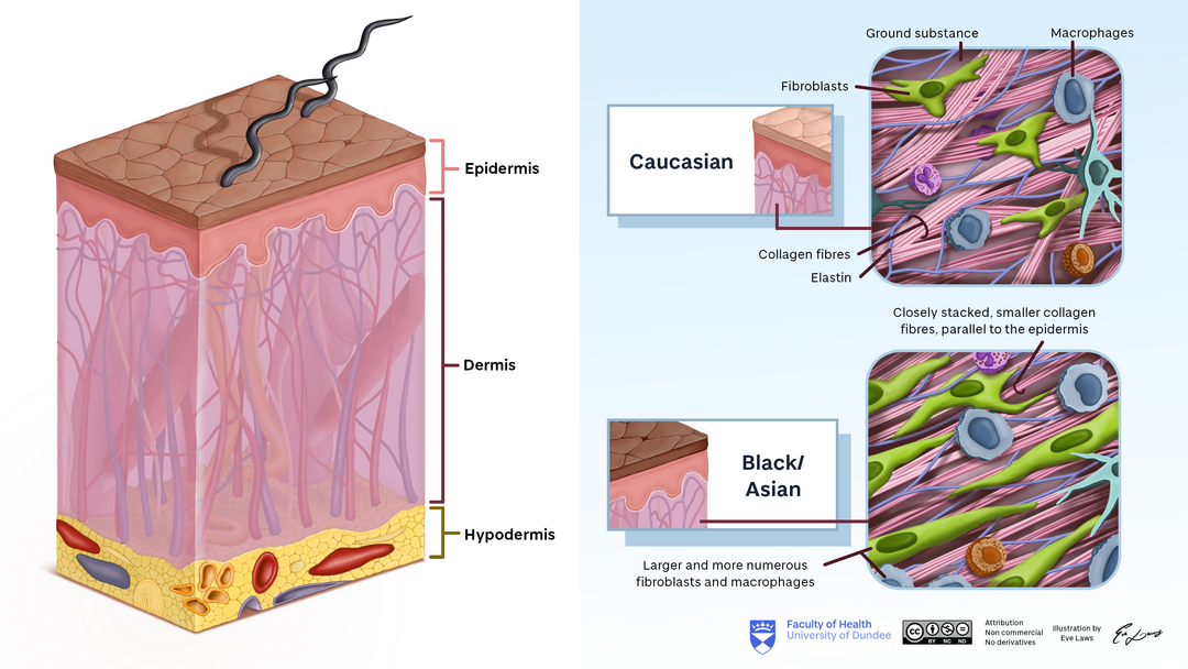 Diagram of the integumentary system showing the epidermis, dermis and hypodermis, accompanied by two diagrams of cellular structure within the dermis for Caucasian, Black and Asian skin. Labelled structures in the cellular diagram: fibroblasts, ground substance, macrophages, collagen fibres and elastin. In Black/Asian skin the collagen fibres are closely stacked and smaller, parallel to the epidermis, and more and larger macrophages and fibroblasts are present.