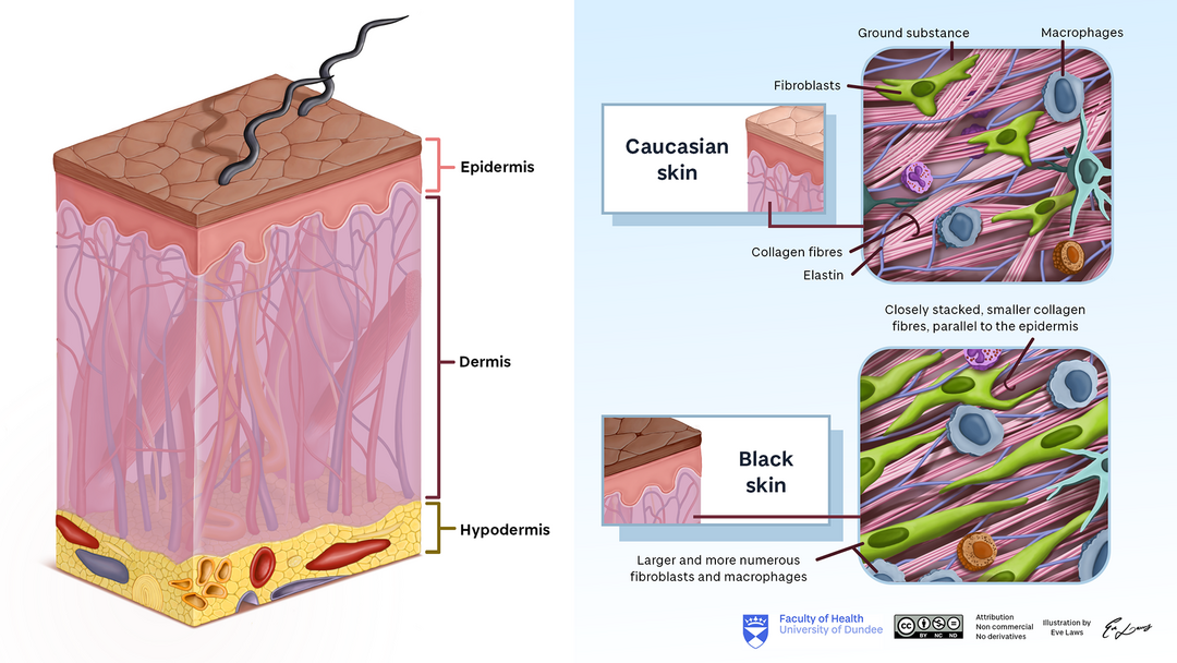 Diagram of the integumentary system showing the epidermis, dermis and hypodermis, accompanied by two diagrams of cellular structure within the dermis for Caucasian, Black and Asian skin. Labelled structures in the cellular diagram: fibroblasts, ground substance, macrophages, collagen fibres and elastin. In Black/Asian skin the collagen fibres are closely stacked and smaller, parallel to the epidermis, and more and larger macrophages and fibroblasts are present.